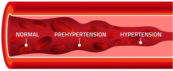 Blood vessel in normal, prehypertension and hypertension stages